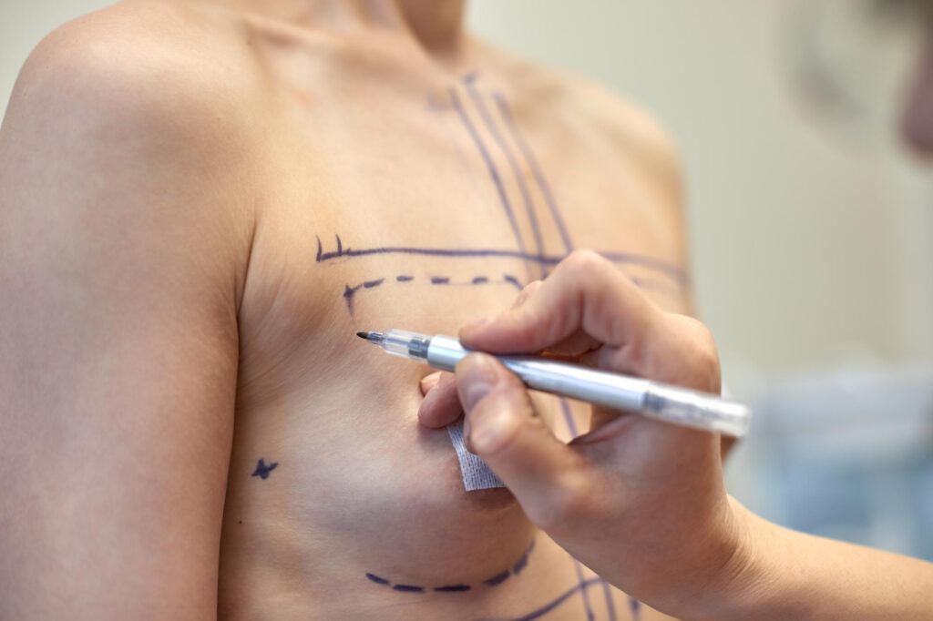 Técnicas para hacer mastectomía masculinizante